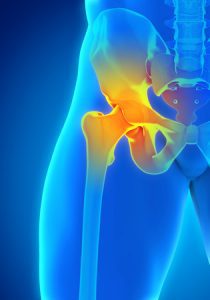 Hip Injury Claim