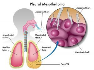 Mesothelioma Compensation