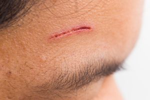 facial scar compensation claims