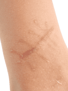 Permanent Scar Injury