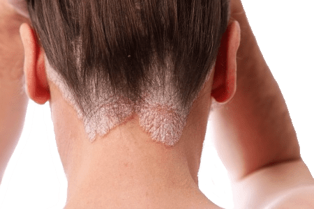 5 750 Compensation For Hair Salon Bleach Burn Claim Free Legal