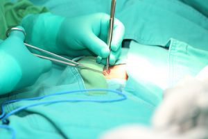 Hernia surgery being performed by a surgeon.