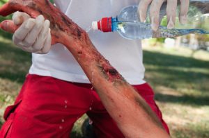 Man wearing gloves pours water from a bottle onto a burnt arm. 
