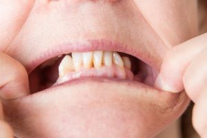 A woman pulling her mouth down to expose her teeth
