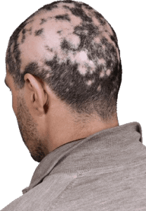 Hair loss