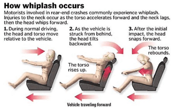 How can I prove I have whiplash