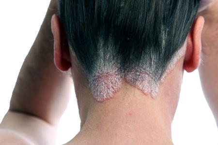 I Had An Allergic Reaction To Hair Dye - Can I Claim Compensation? - Legal  Expert