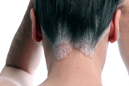 Covid19 New allergic reactions to hair dye reported  BBC News