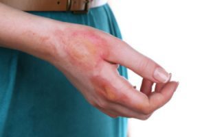 chemical burn at work compensation