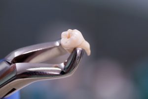 Wrong Tooth Extraction Claims