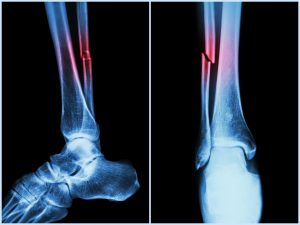 ankle injury compensation amounts