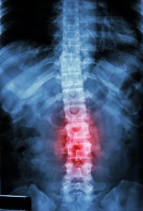 serious spine injury claims