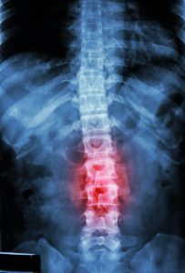 An X-Ray of a spine with a red pulsating injury mid-spine