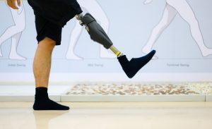 Man with prosthetic leg learning how to walk again
