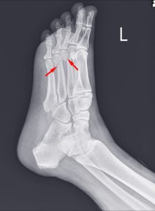 FOOT X-RAY SHOWING BROKEN BONES IN RED