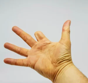 A photo of a person's hand missing their index finger.